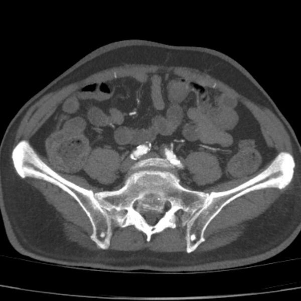 File:Bilateral superficial femoral arterial occlusion (Radiopaedia 25682-25857 A 17).jpg