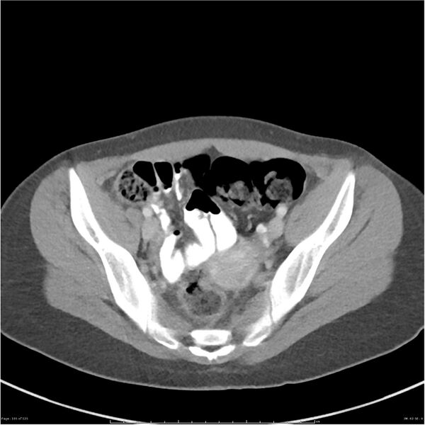 File:Bilateral ureteritis and cystitis (Radiopaedia 25340-25594 A 62).jpg