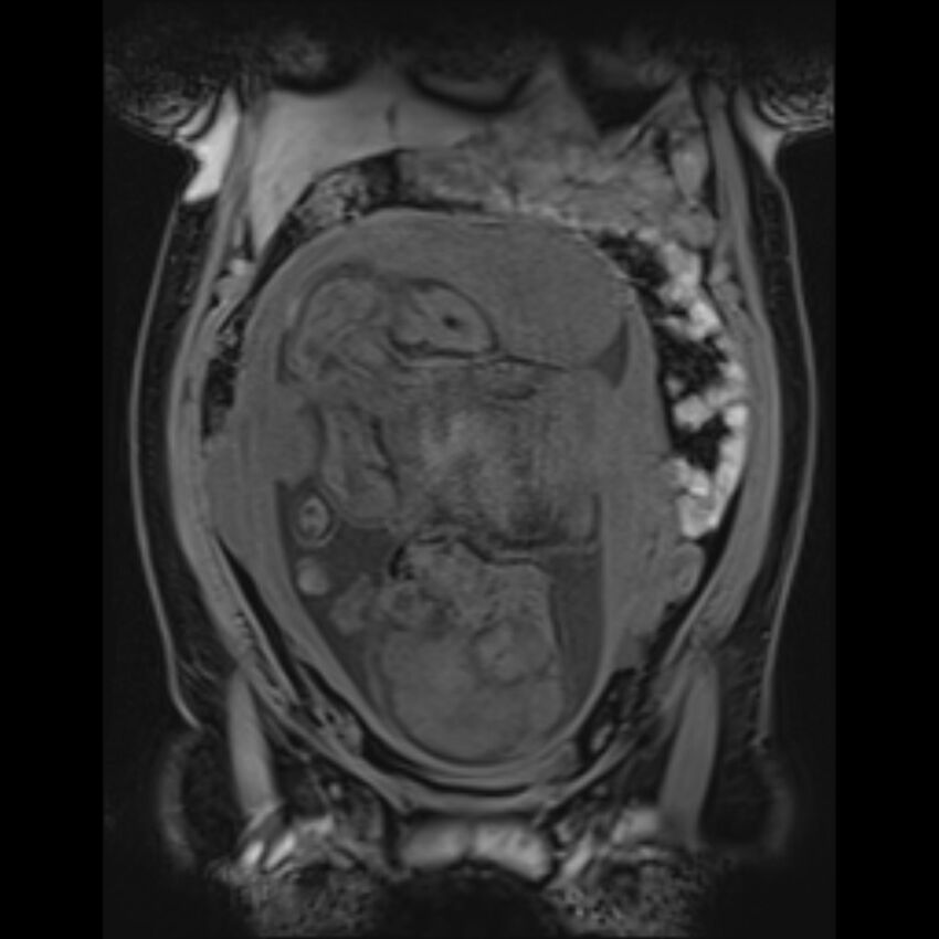 Bilobed placenta accreta (Radiopaedia 69648-79591 Coronal T1 vibe 62).jpg