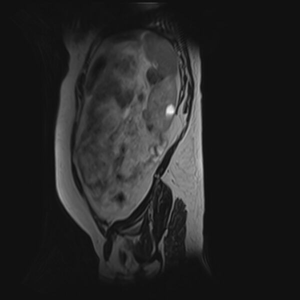 File:Bilobed placenta accreta (Radiopaedia 69648-79591 G 8).jpg