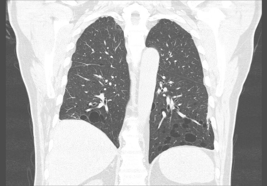 Birt-Hogg-Dubé syndrome (Radiopaedia 52578-58491 Coronal lung window 42).jpg