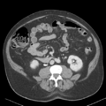 Bladder papillary urothelial carcinoma (Radiopaedia 48119-52951 Axial 28).png