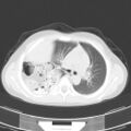 Bochdalek diaphragmatic hernia (Radiopaedia 38866-41059 Axial lung window 9).jpg