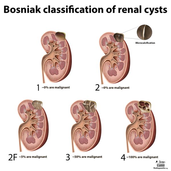 File:Bosniak classification of renal cysts (illustrations) (Radiopaedia 20989-20926 None 1).jpg