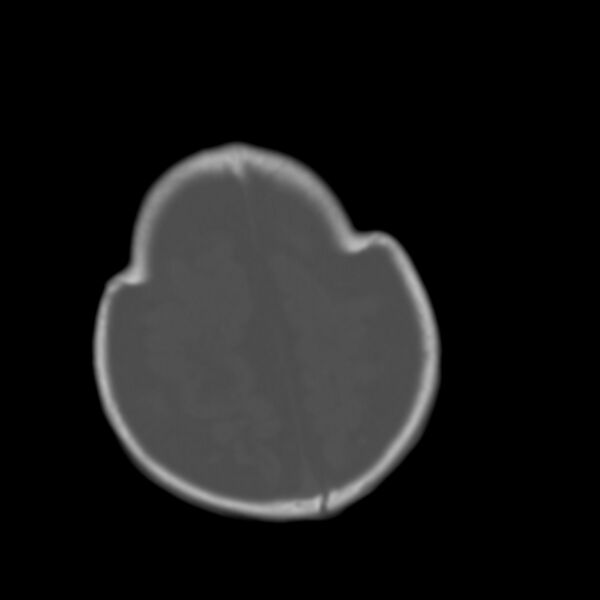 File:Brachycephaly (bi-coronal and bi-lambdoid synostosis) (Radiopaedia 55048-61413 Axial bone window 21).jpg