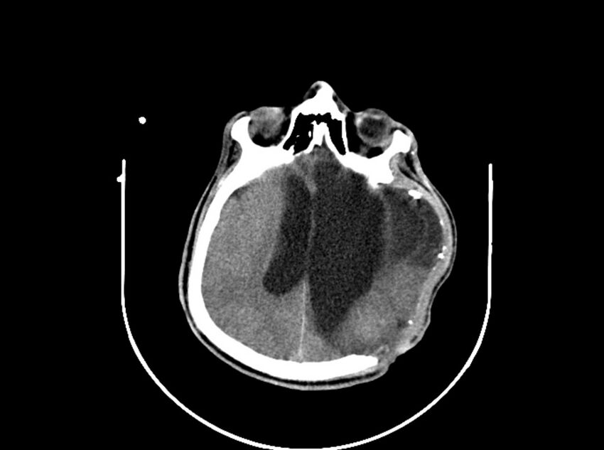 Brain injury by firearm projectile (Radiopaedia 82068-96088 A 136).jpg