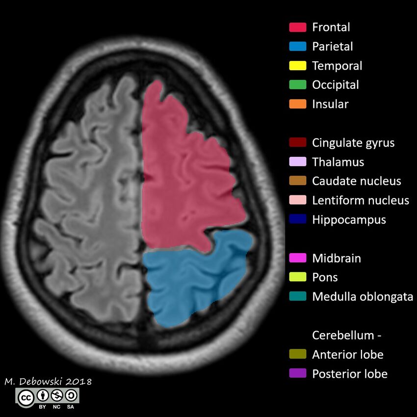 Brain lobes - annotated MRI (Radiopaedia 61691-69700 Axial 14).JPG