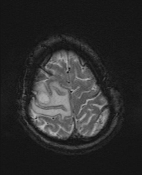 File:Brain metastases - lung cancer primary (Radiopaedia 75060-86115 Axial SWI 53).jpg
