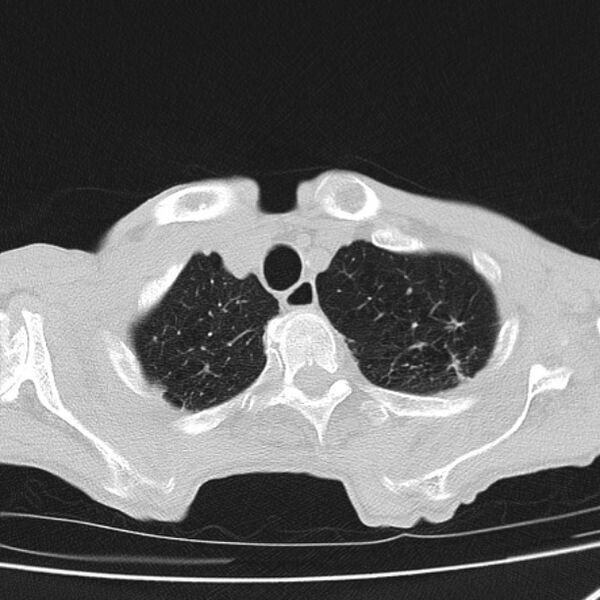 File:Brain metastases from lung cancer (Radiopaedia 27849-28093 Axial lung window 9).jpg