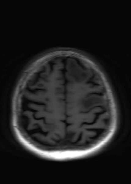 File:Brain metastases from squamocellular lung cancer (Radiopaedia 56515-63222 Axial T1 20).jpg