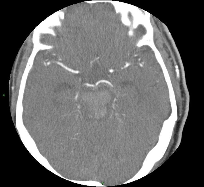 File:Brainstem hemorrhage (Radiopaedia 58794-66028 D 77).jpg