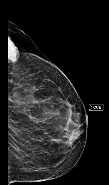 File:Breast fibroadenoma (Radiopaedia 82986-97340 D 1).jpg
