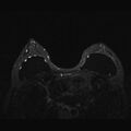 Breast implants - MRI (Radiopaedia 26864-27035 T2 SPAIR 29).jpg