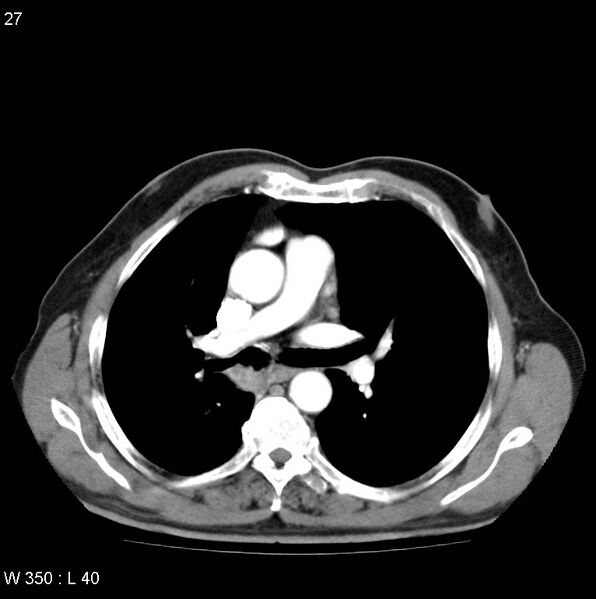 File:Bronchial carcinoid tumor with right lower lobe collapse (Radiopaedia 29060-29422 A 26).jpg