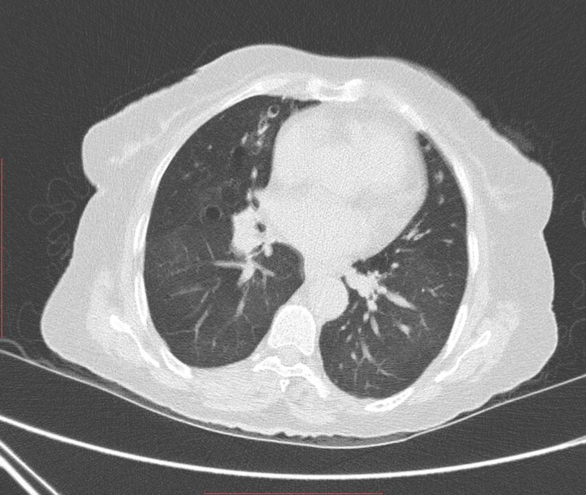 Bronchiectasis (Radiopaedia 72693-83293 Axial lung window 76).jpg