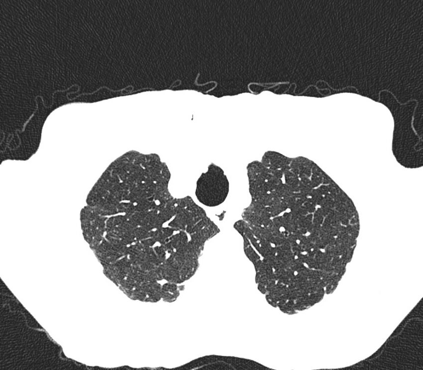 Bronchiolitis (Radiopaedia 24616-24887 Axial lung window 5).jpg