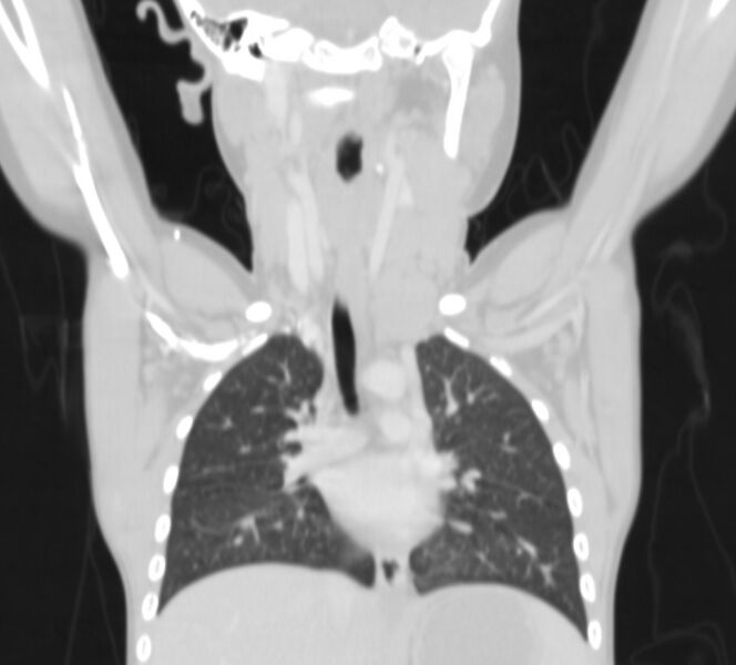 File:Bronchus suis (Radiopaedia 68131-77620 Coronal lung window 4).jpg