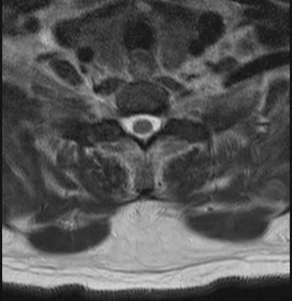 File:Brown tumors compressing the spinal cord (Radiopaedia 68442-78030 A 54).jpg