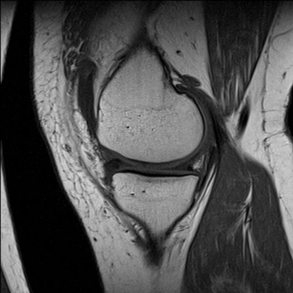 File:Bucket handle tear - medial meniscus (Radiopaedia 79028-91942 Sagittal T1 18).jpg