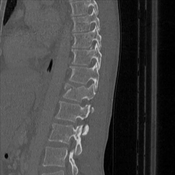 File:Bulging of paraspinal line in traumatic thoracal spinal compression fracture (Radiopaedia 29221-35872 Sagittal bone window 38).jpg
