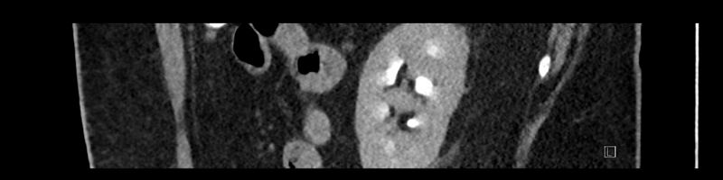 File:Buried bumper syndrome - gastrostomy tube (Radiopaedia 63843-72575 Sagittal Inject 29).jpg