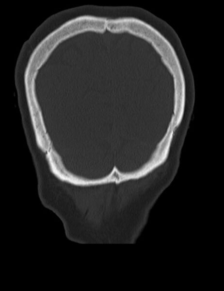 File:Burnt-out meningioma (Radiopaedia 51557-57337 Coronal bone window 48).jpg
