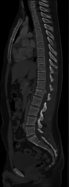 File:Burst fracture (Radiopaedia 83168-97542 Sagittal bone window 66).jpg
