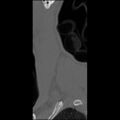 C5 facet fracture (Radiopaedia 58374-65499 Sagittal bone window 7).jpg