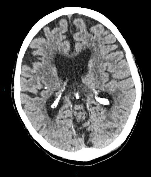 File:Calcified cerebral emboli from left ventricular thrombus (Radiopaedia 84420-99758 Axial non-contrast 46).jpg