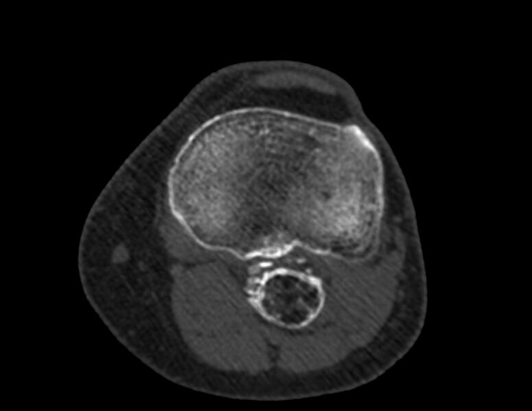 File:Calcified hematoma - popliteal fossa (Radiopaedia 63938-72763 Axial bone window 47).jpg