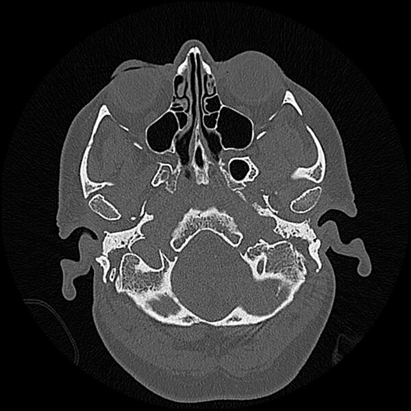 File:Canal up mastoidectomy (Radiopaedia 78108-90638 Axial bone window 29).jpg