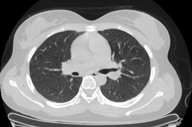 File:Cannonball metastases - uterine choriocarcinoma (Radiopaedia 70137-80173 Axial lung window 39).jpg