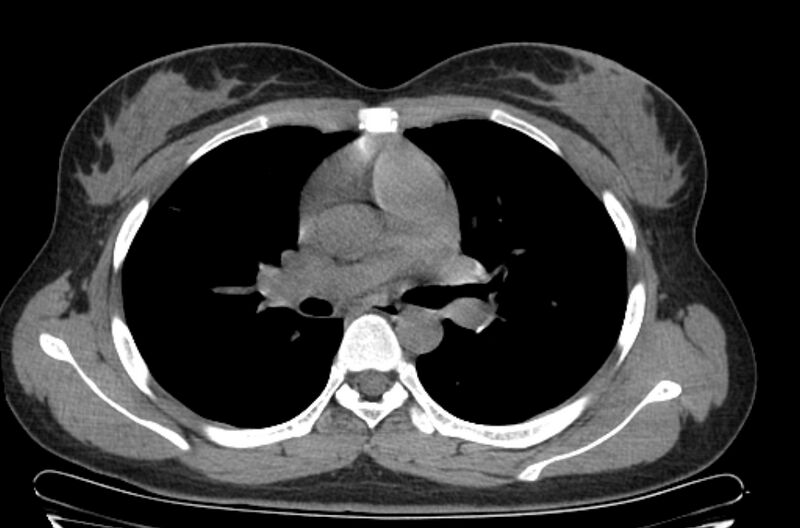 File:Cannonball metastases - uterine choriocarcinoma (Radiopaedia 70137-80173 Axial non-contrast 47).jpg