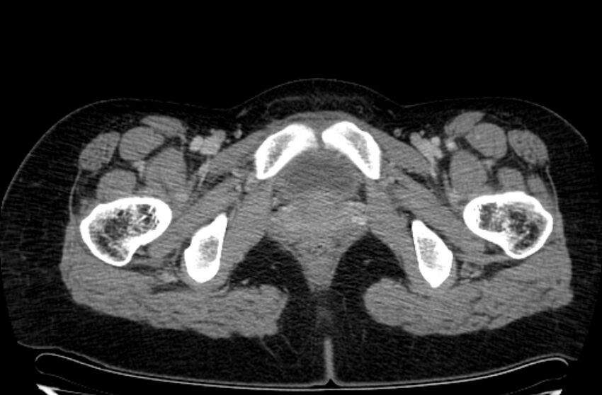 Cannonball metastases - uterine choriocarcinoma (Radiopaedia 70137-80174 A 62).jpg