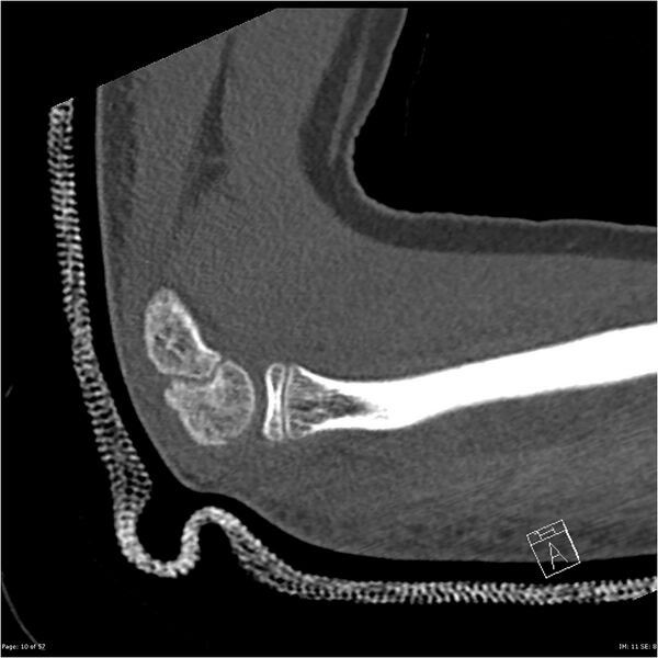 File:Capitellum fracture (Radiopaedia 23352-23426 Sagittal bone window 10).jpg