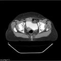 Carcinoma cervix- recurrence (Radiopaedia 34702-36137 B 87).jpg
