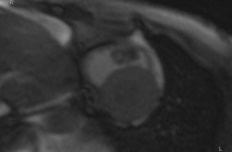 File:Cardiac hemangioma (Radiopaedia 31709-32631 Short axis 76).jpg
