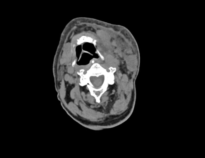 File:Carotid artery pseudoaneurysm (Radiopaedia 84030-99259 Axial non-contrast 17).jpg