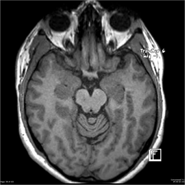 File:Cavernous malformation (cavernous angioma or cavernoma) (Radiopaedia 36675-38237 Axial T1 47).jpg