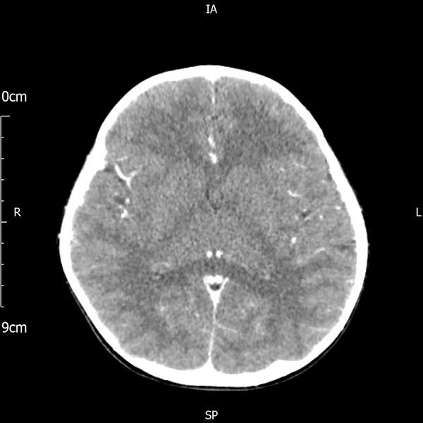 File:Cavernous sinus thrombosis (Radiopaedia 79414-92510 Axial Brain 108).jpg
