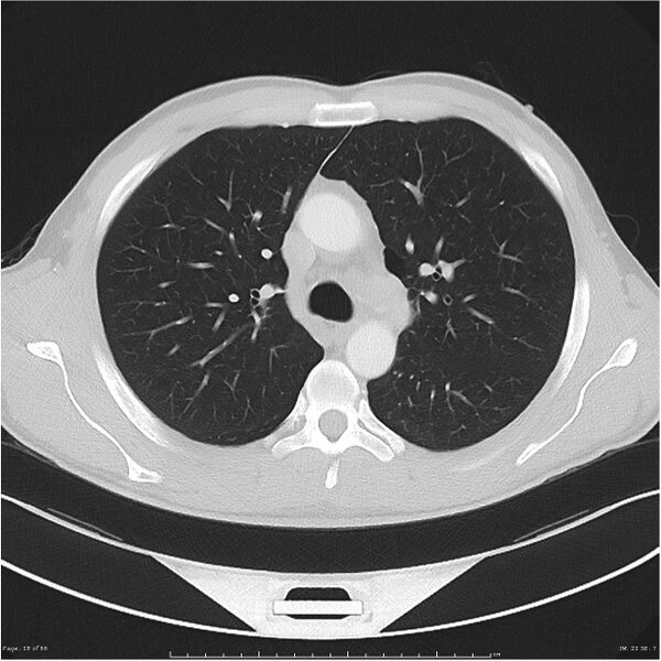 File:Cavitating lung cancer (Radiopaedia 25796-25945 Axial lung window 18).jpg