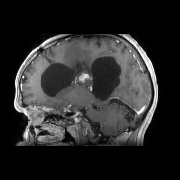 File:Central neurocytoma (Radiopaedia 67618-77021 Sagittal T1 C+ 12).jpg