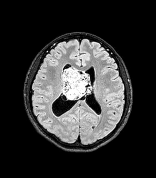 File:Central neurocytoma (Radiopaedia 79320-92380 Axial FLAIR 130).jpg