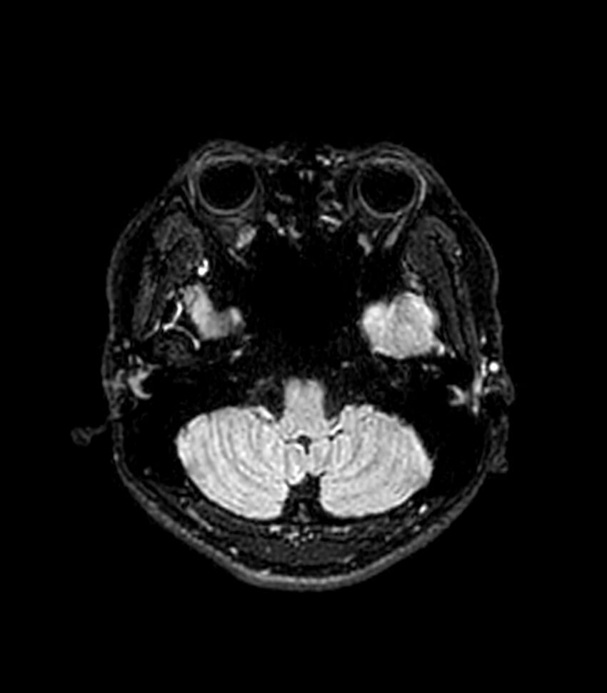 Central neurocytoma (Radiopaedia 79320-92380 Axial FLAIR 240).jpg