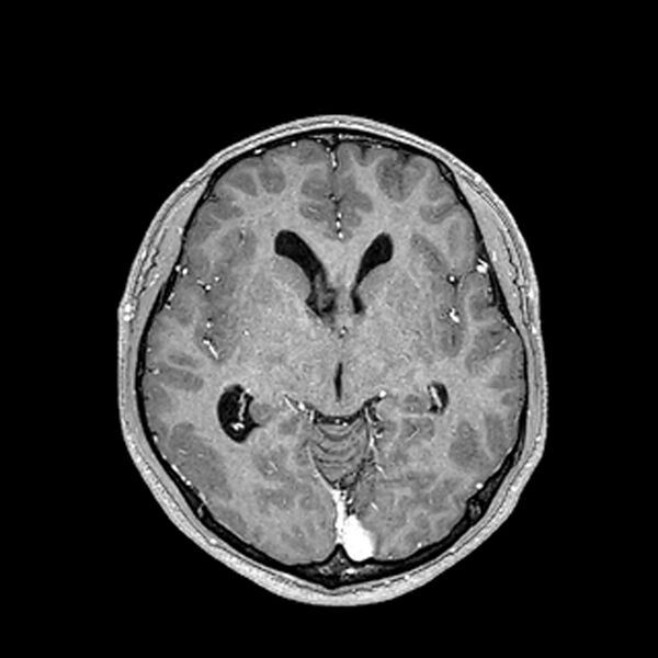File:Central neurocytoma (Radiopaedia 79320-92380 Axial T1 C+ 116).jpg