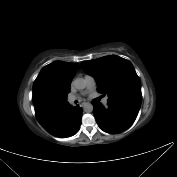 File:Centrilobular pulmonary emphysema (Radiopaedia 24495-24789 Axial non-contrast 25).jpg