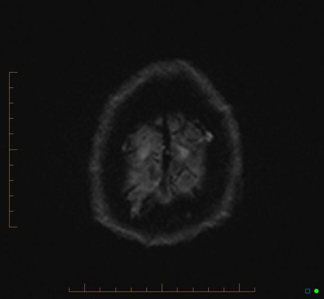 File:Cerebellar gangliocytoma (Radiopaedia 65377-74422 Axial DWI 38).jpg