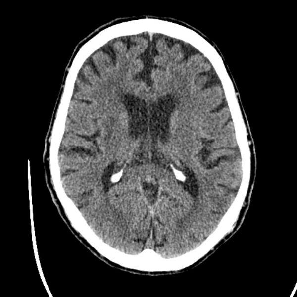 File:Cerebellar hemorrhage (Radiopaedia 27193-27359 Axial non-contrast 28).jpg