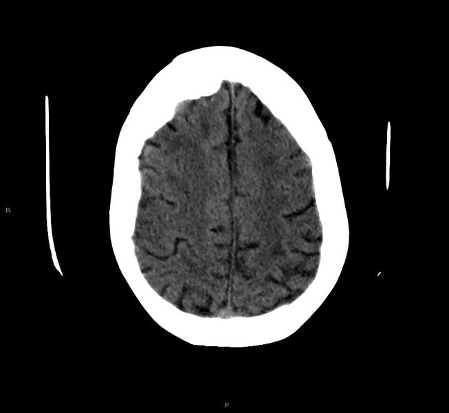 File:Cerebellar hemorrhage (Radiopaedia 58792-66026 Axial non-contrast 13).jpg