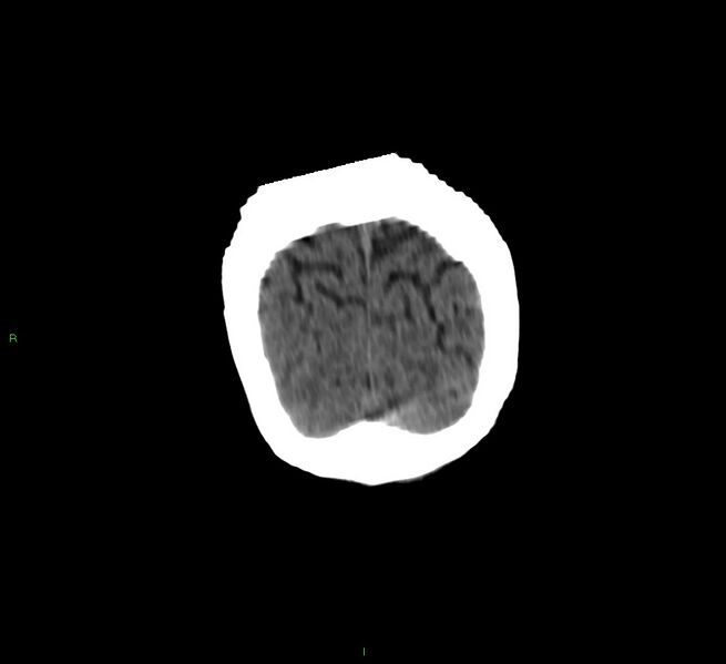 File:Cerebellar hemorrhage (Radiopaedia 58792-66026 Coronal non-contrast 9).jpg